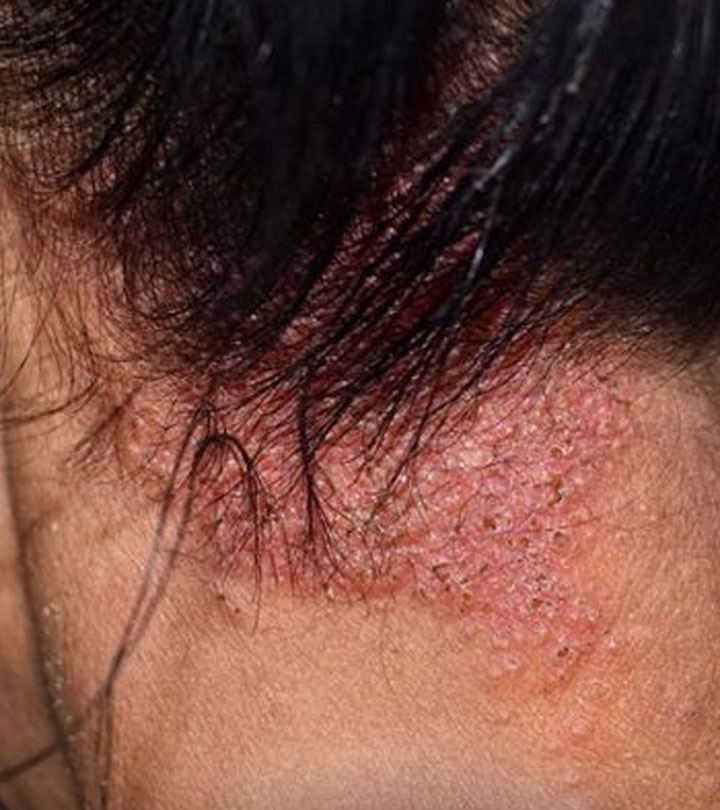 Fungal Infection On Scalp
